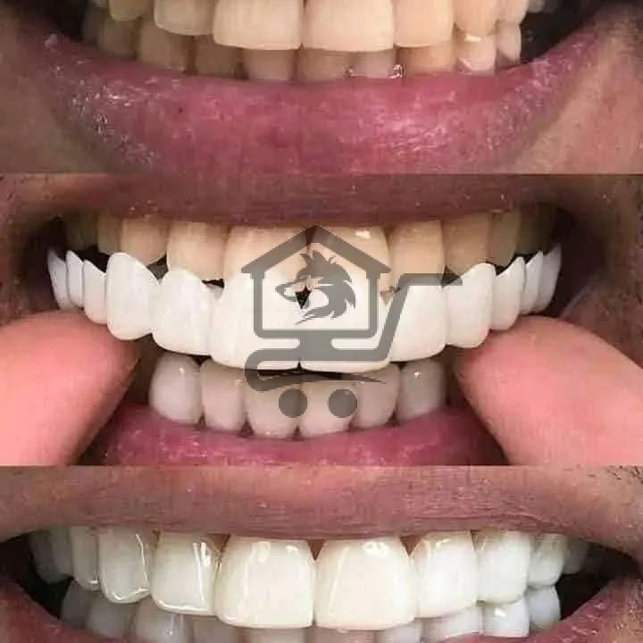 فينير متحرك للأسنان