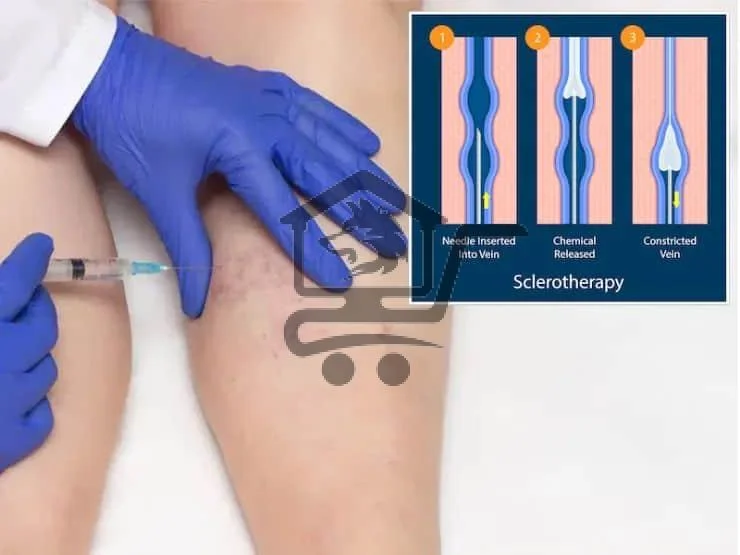 معالجة الدوالي بأحدث الطرق - الصورة 5